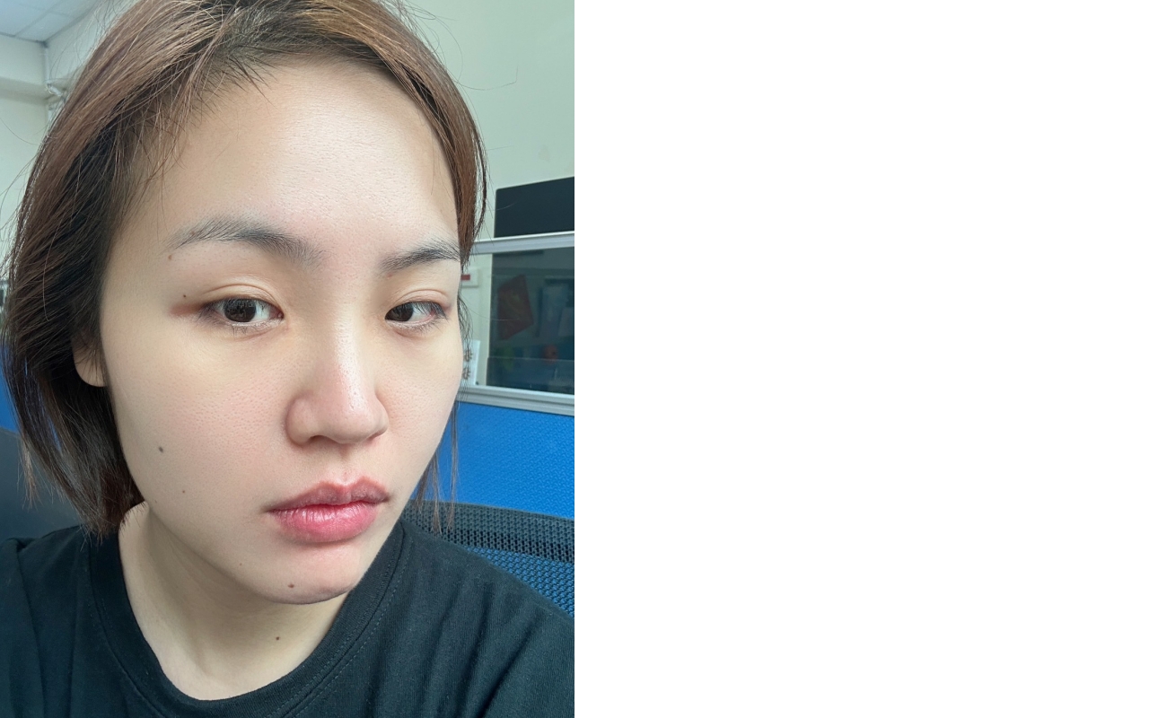 【愛爾麗診所 HIPRO-S 龍捲風音波拉提】台北音波拉提診所分享|輪廓線醫美體驗心得,無痛打造緊實V臉! - 第4張圖 愛爾麗診所 HIPRO-S 龍捲風音波拉提